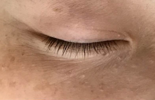 甲状腺癌是如何治疗